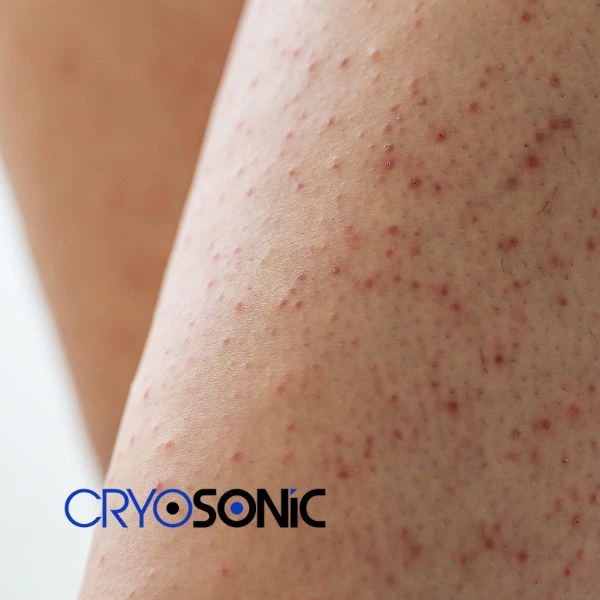 Looking for Seborrhoeic Keratosis removal Basingstoke treatment? Call our consultants today in Basingstoke