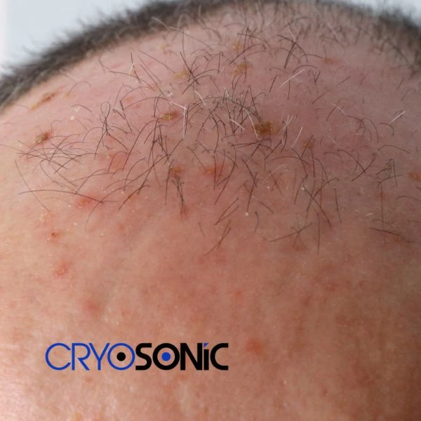 Access Seborrhoeic Keratosis removal from the comfort of your own home! Call us today in Basingstoke