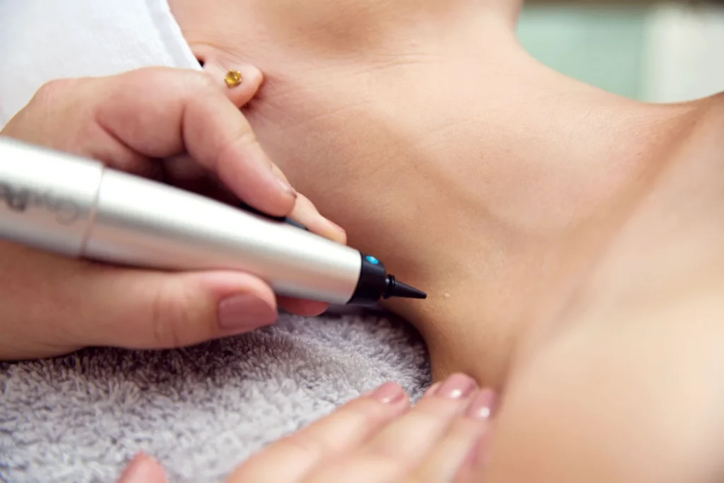 CryoPen precisely treating Molluscum Contagiosum lesions, showing safe and effective removal for faster healing by Cryosonic Basingstoke