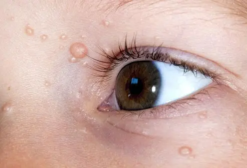 CryoPen treating persistent Molluscum Contagiosum Basingstoke lesions Basingstoke