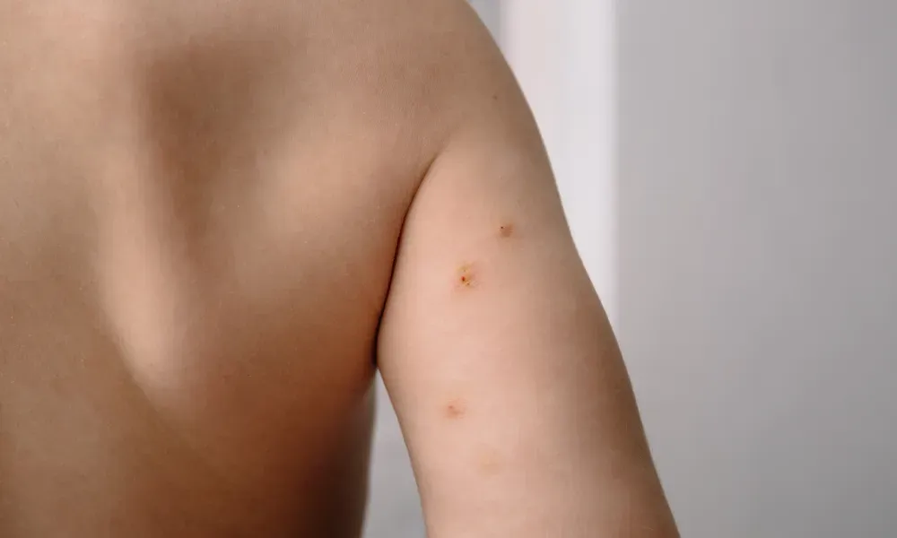 CryoPen treating Molluscum Contagiosum Basingstoke professionally, highlighting safe and precise lesion removal for improved skin and confidence Basingstoke