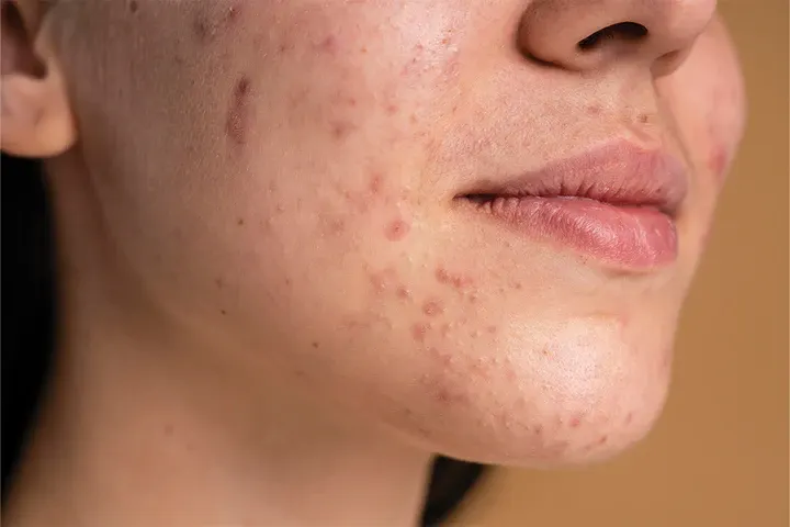 CryoPen precisely removing Skin Tags (fibroepithelial polyps), showing safe and effective treatment for smoother, clearer skin Basingstoke