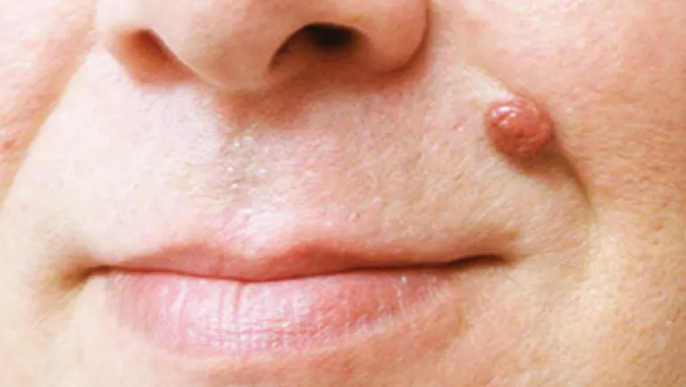 CryoPen safely removing Skin Tags Basingstoke, showing minimal recurrence risk and precise treatment for smoother, clear skin by Cryosonic Basingstoke