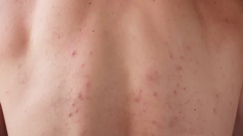 CryoPen treating Basingstoke Molluscum Contagiosum lesions safely and precisely, illustrating answers to common patient FAQs Basingstoke