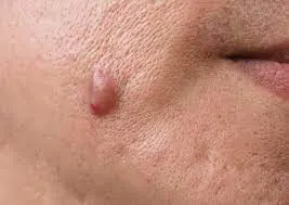 common causes of Skin Tags Basingstoke formation, including friction, genetics, and hormonal changes Basingstoke