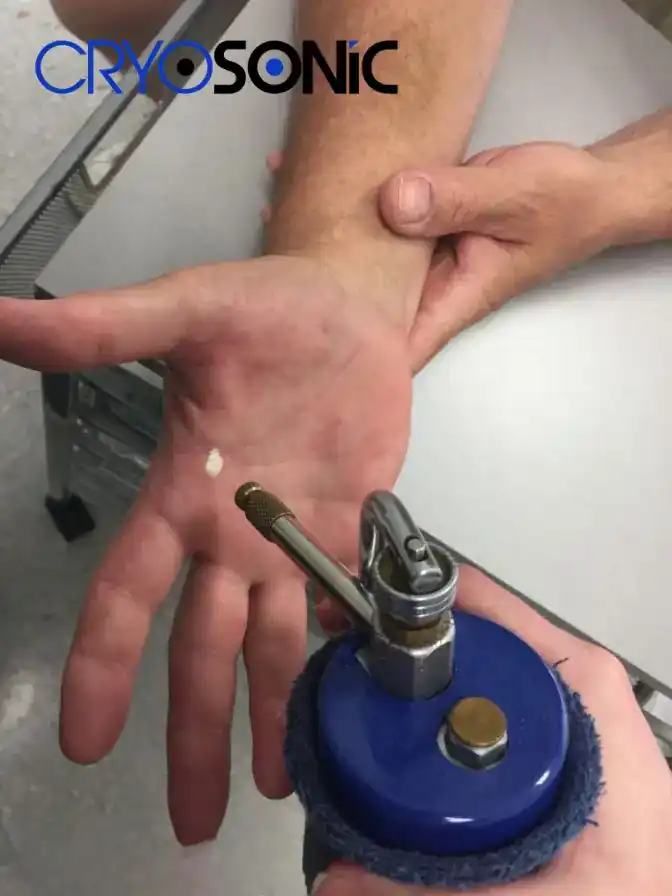 Temperature Differences: OTC vs Medical-Grade Cryotherapy Basingstoke